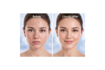 AcneX acne removel